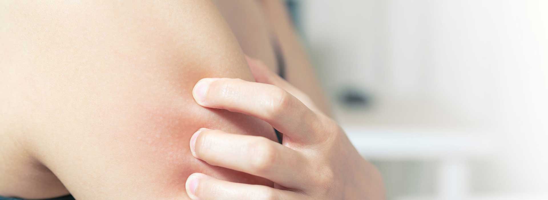 Woman using CBD for her Psoriasis